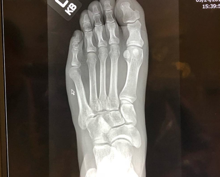 Ankle Issues??