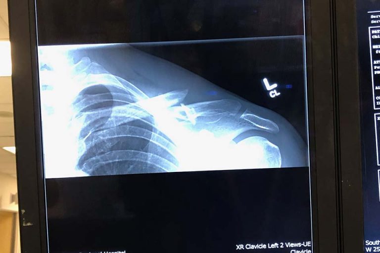 My Broken Collarbone Story of 2020